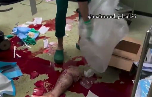 Thumbnail preview image for the video titled: Bloody scene at a hospital following a leg amputation without anesthesia