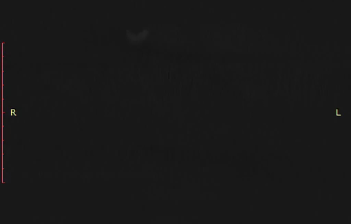 Thumbnail preview image for the video titled: This girl's injuries are typical of patients from GHF "aid" sites