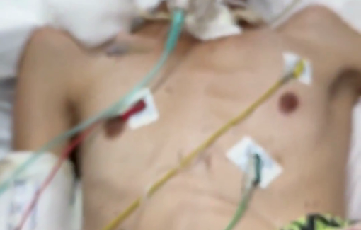 Thumbnail preview image for the video titled: 17 year-old shot at a Rafah GHF site, now hemiplegic