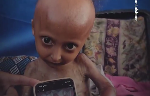 Thumbnail preview image for the video titled: Ailing child Hala Al-Hanadi's condition worsens from malnutrition
