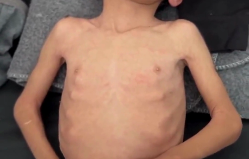 Thumbnail preview image for the video titled: 4-year-old Mohammad Abu Hosayn has his body reduced to skin and bone from acute malnutrition