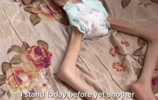 Thumbnail preview image for the video titled: Child Rahaf Al-Balawi is collapsing due to famine in Gaza after she has lost 80% of her body weight