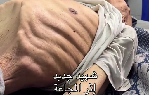 Thumbnail preview image for the video titled: An elderly man has died of starvation in Gaza