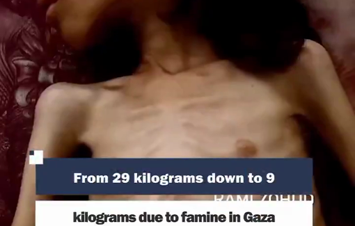 Thumbnail preview image for the video titled: The girl Maryam Dawas suffers from severe malnutrition due to the genocidal Israeli siege on Gaza