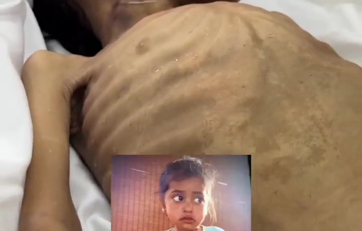 Thumbnail preview image for the video titled: 5 year-old Aalaa Al-Arja killed by malnutrition due to Israel's starvation policy